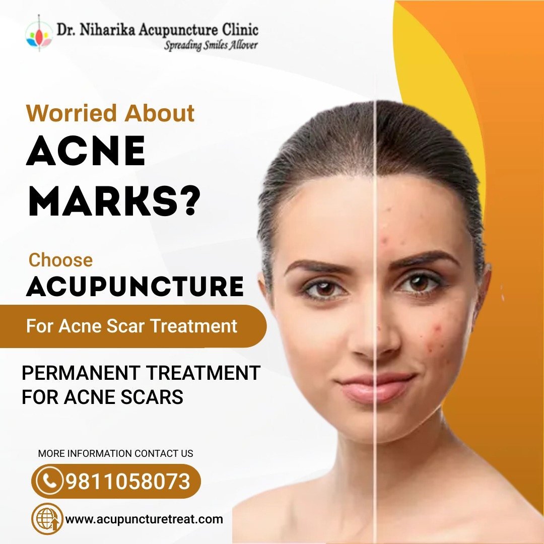 Acupuncture Clinic In Delhi